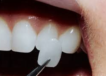 Veneers